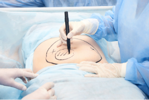 CentralSurgery tummy tuck Adelaide