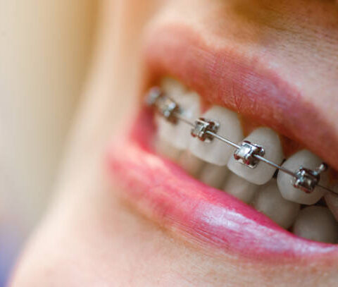 dental braces Adelaide