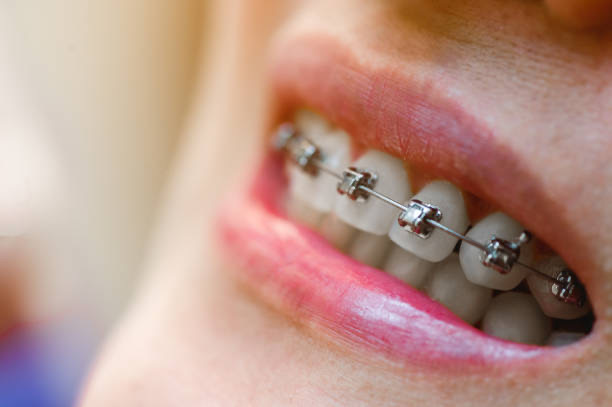 dental braces Adelaide