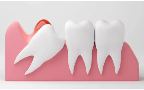 wisdom teeth removal Adelaide