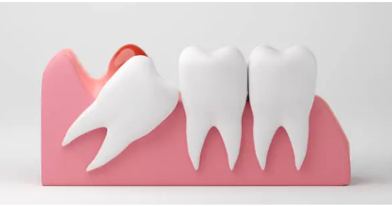 wisdom teeth removal Adelaide